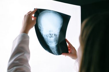 Estimating the Costs of Treating a Severe Brain Injury